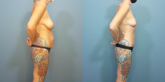 Before & After Tummy Tuck (Abdominoplasty) Case 291 Right Side View in Portland, OR
