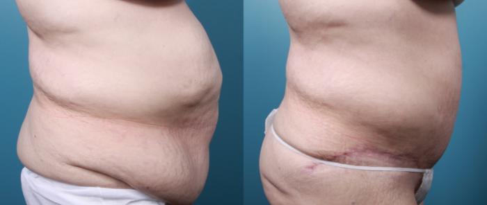 Before & After Massive Weight Loss/Body Lift Case 30 View #2 View in Portland, OR