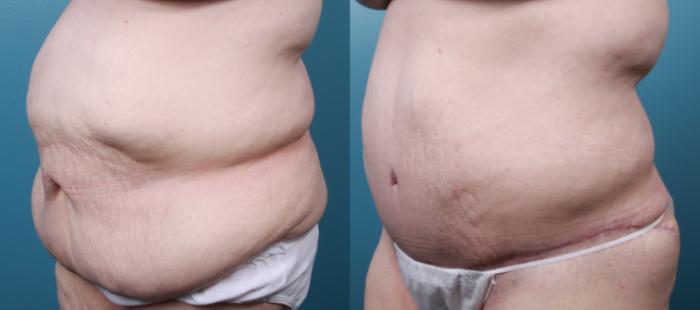 Before & After Massive Weight Loss/Body Lift Case 30 View #3 View in Portland, OR