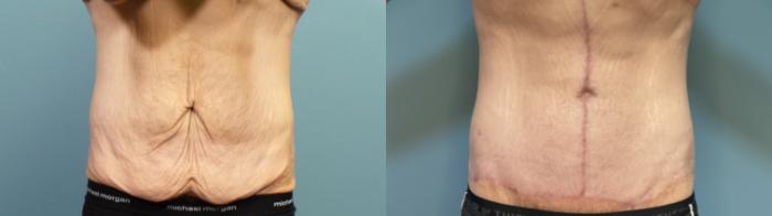 Before & After Massive Weight Loss/Body Lift Case 327 Front View in Portland, OR