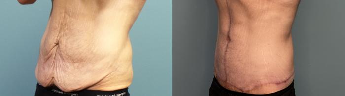 Before & After Massive Weight Loss/Body Lift Case 327 Left Oblique View in Portland, OR
