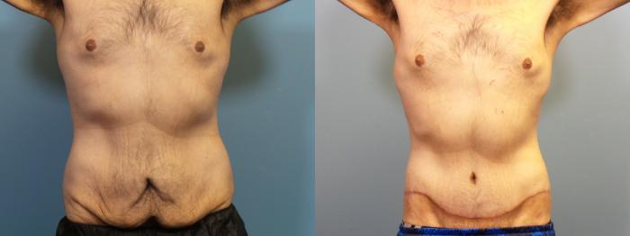 Before & After Massive Weight Loss/Body Lift Case 338 Front View in Portland, OR
