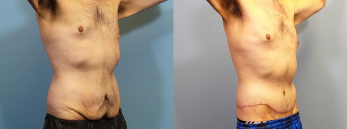 Before & After Massive Weight Loss/Body Lift Case 338 Right Oblique View in Portland, OR