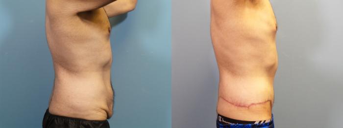 Before & After Massive Weight Loss/Body Lift Case 338 Right Side View in Portland, OR