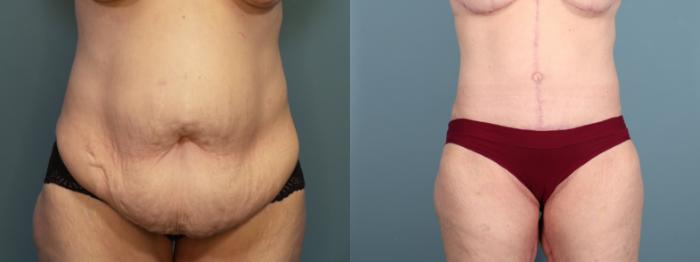 Before & After Tummy Tuck (Abdominoplasty) Case 397 Front View in Portland, OR