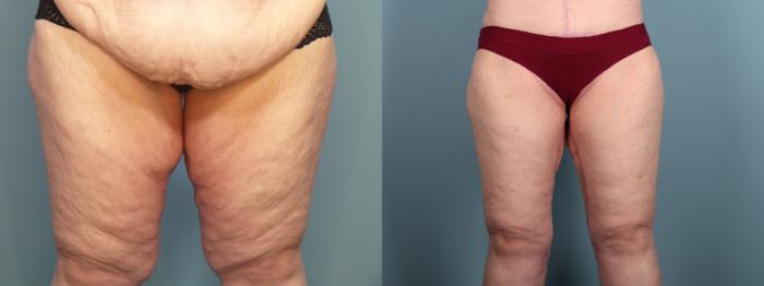 Before & After Thigh Lift Case 397 View 2 View in Portland, OR
