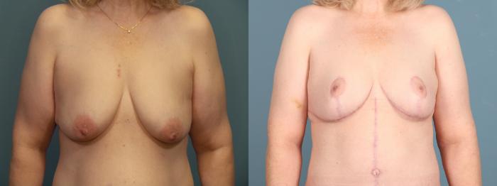 Before & After Breast Lift Case 397 View 3 View in Portland, OR