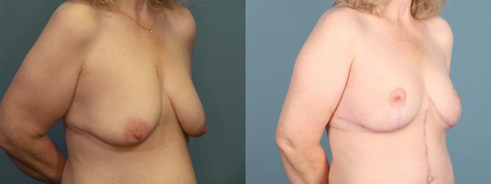 Before & After Breast Lift Case 397 View 4 View in Portland, OR