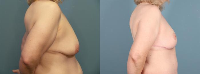 Before & After Breast Lift Case 397 View 5 View in Portland, OR