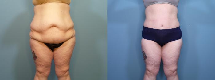 Before & After Tummy Tuck (Abdominoplasty) Case 404 Front View in Portland, OR