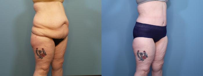 Before & After Liposuction Case 404 Right Oblique View in Portland, OR