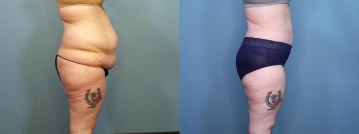 Before & After Tummy Tuck (Abdominoplasty) Case 404 Right Side View in Portland, OR