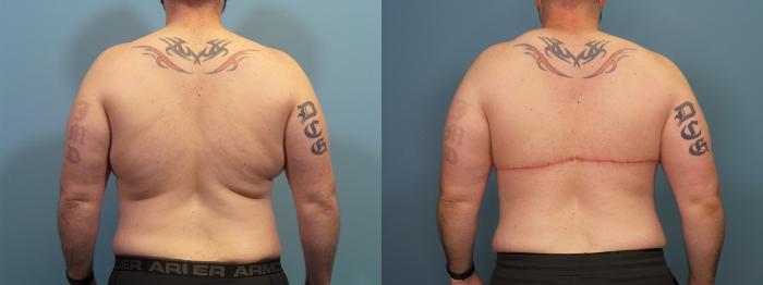 Before & After Massive Weight Loss/Body Lift Case 435 Back View in Portland, OR