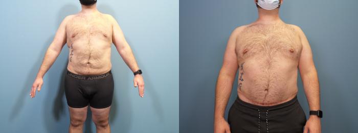 Before & After Massive Weight Loss/Body Lift Case 435 Front View in Portland, OR