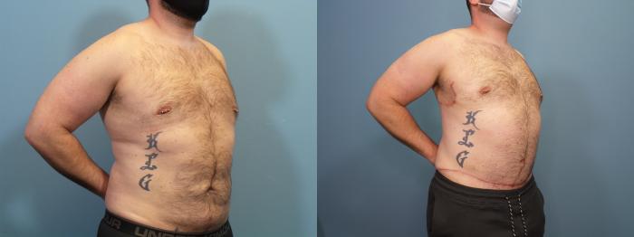 Before & After Massive Weight Loss/Body Lift Case 435 Right Oblique View in Portland, OR