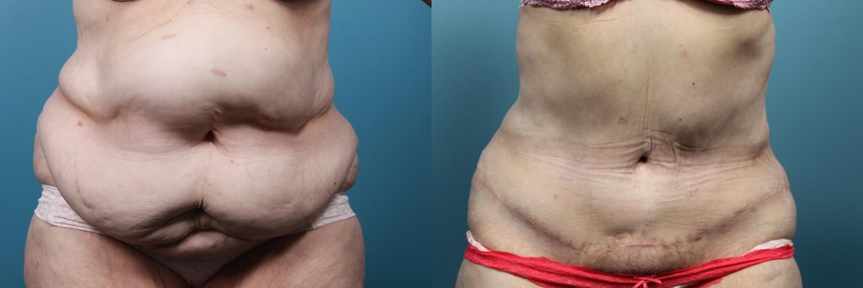 Before & After Massive Weight Loss/Body Lift Case 69 View #1 View in Portland, OR
