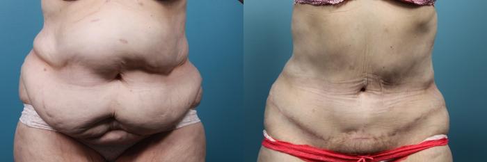 Plastic Surgery Case Study - Waist Reduction In A Female Body