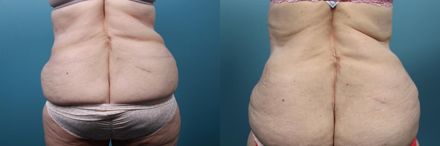 Before & After Massive Weight Loss/Body Lift Case 69 View #3 View in Portland, OR