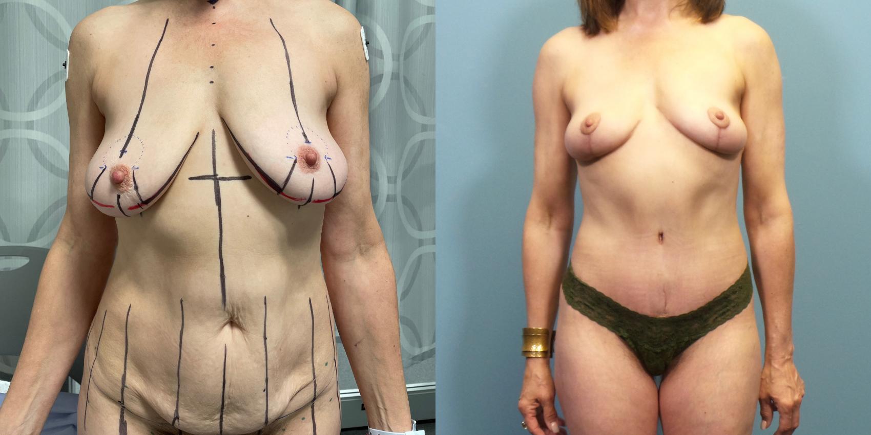 Before & After Tummy Tuck (Abdominoplasty) Case 271 Front View in Portland, OR