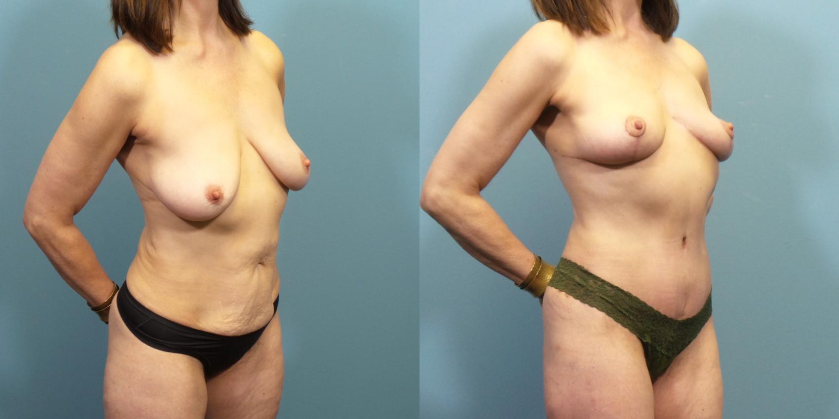 Before & After Tummy Tuck (Abdominoplasty) Case 271 Right Oblique View in Portland, OR