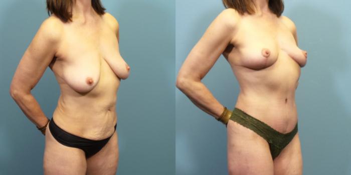 Before & After Breast Reduction Case 271 Right Oblique View in Portland, OR