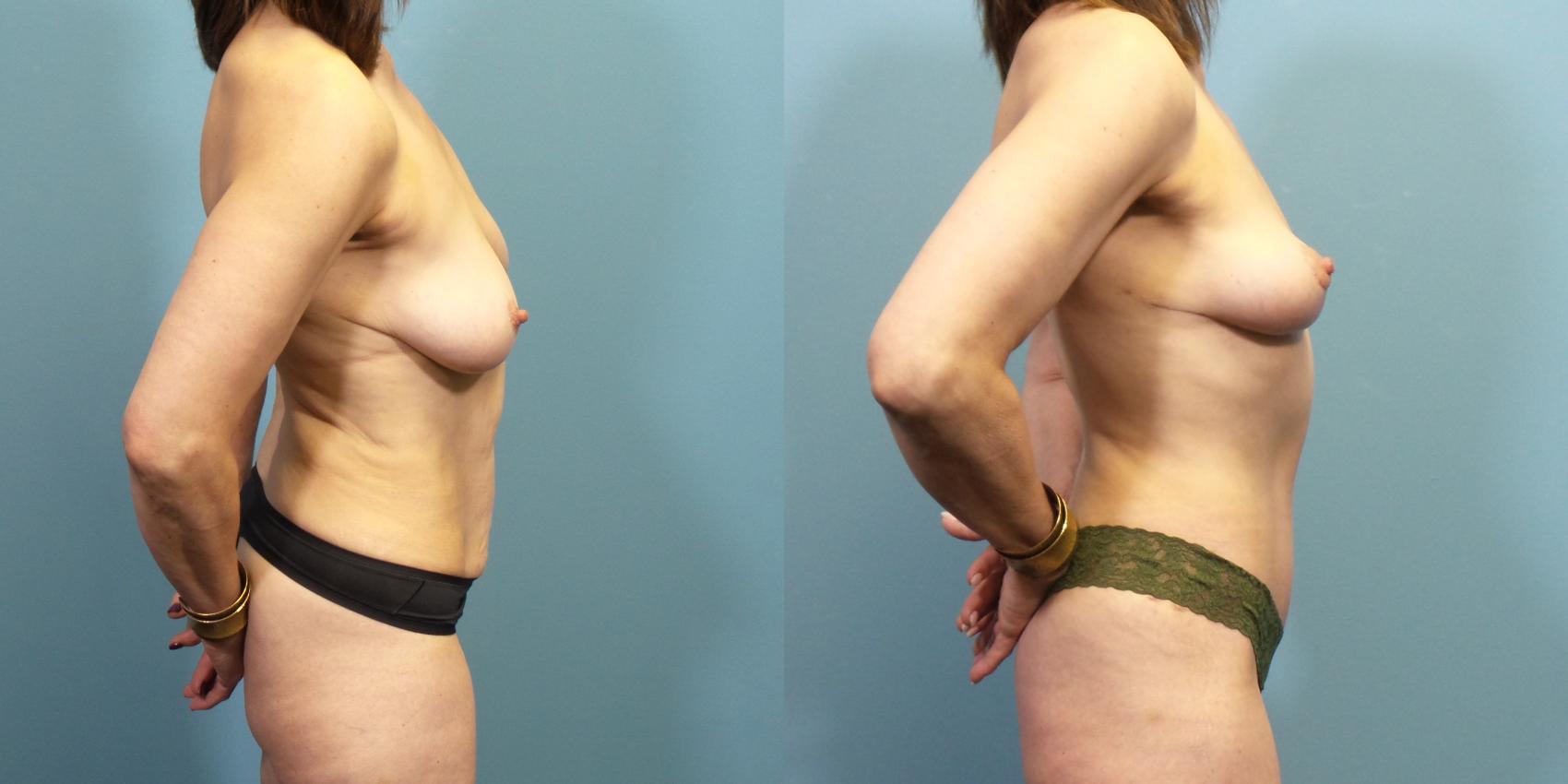Before & After Tummy Tuck (Abdominoplasty) Case 271 Right Side View in Portland, OR