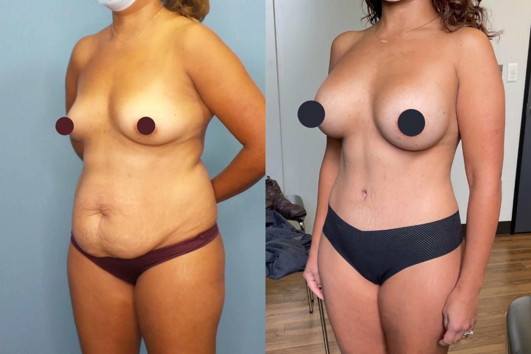 Before & After Tummy Tuck (Abdominoplasty) Case 275 Left Oblique View in Portland, OR