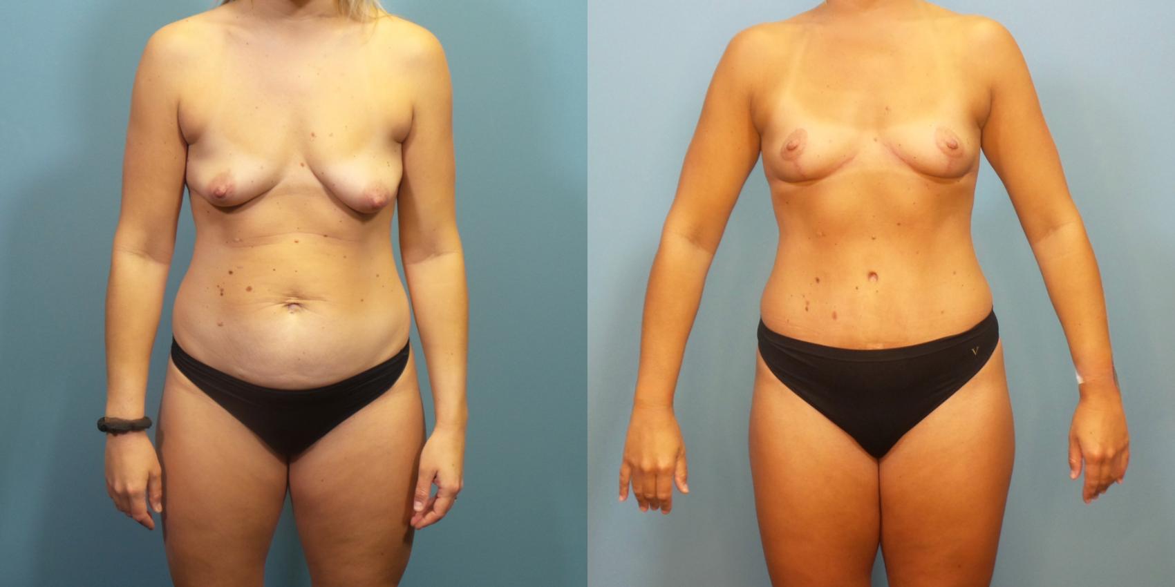 Before & After Tummy Tuck (Abdominoplasty) Case 277 Front View in Portland, OR