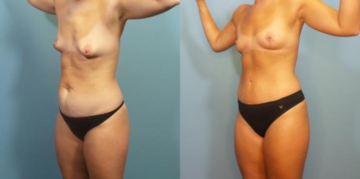 Before & After Tummy Tuck (Abdominoplasty) Case 277 Left Oblique View in Portland, OR