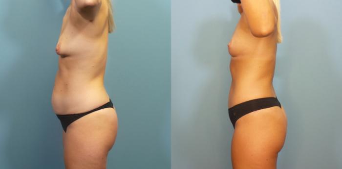 Before & After Tummy Tuck (Abdominoplasty) Case 277 Left Side View in Portland, OR