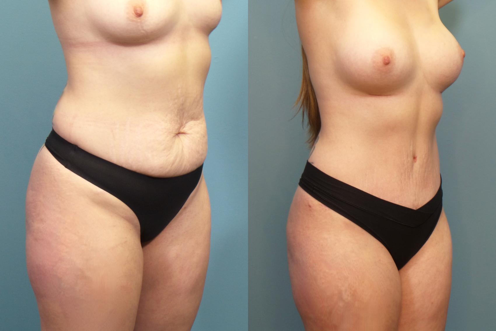 Before & After Tummy Tuck (Abdominoplasty) Case 278 Right Oblique View in Portland, OR