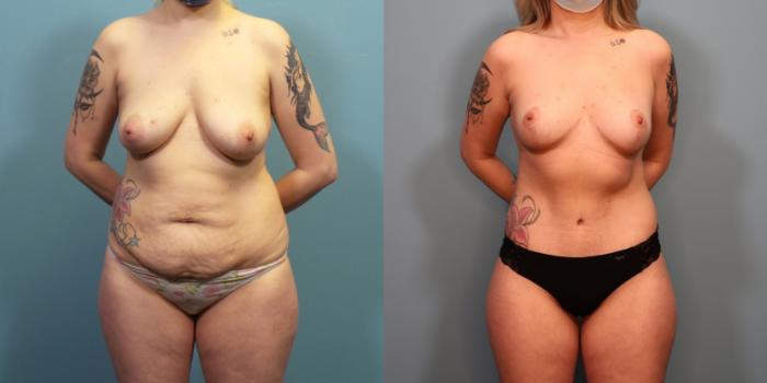 Before & After Massive Weight Loss/Body Lift Case 293 Front View in Portland, OR