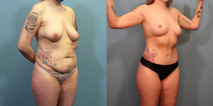 Before & After Mommy Makeover Case 293 Right Oblique View in Portland, OR