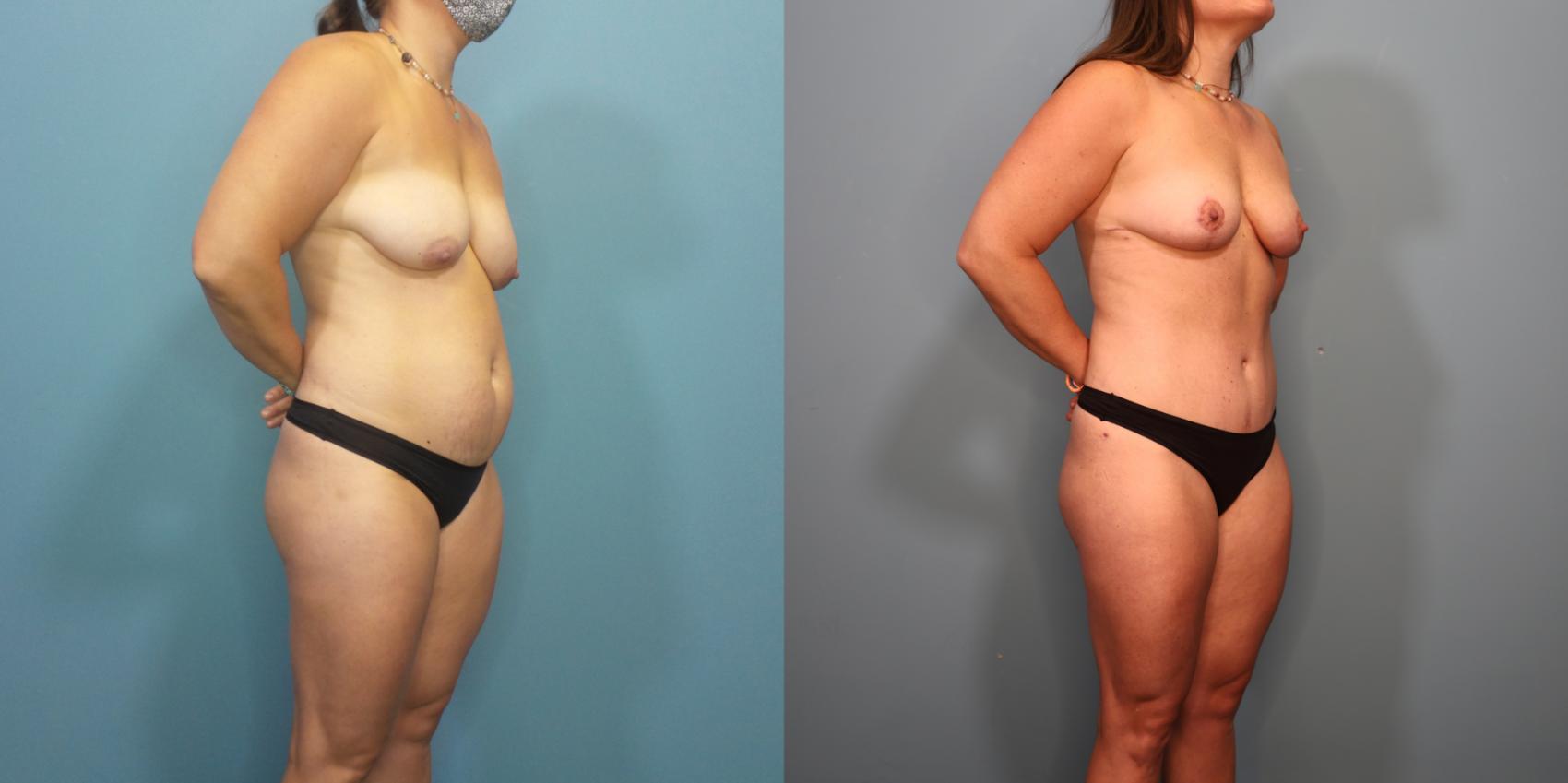 Before & After Tummy Tuck (Abdominoplasty) Case 297 Right Oblique View in Portland, OR
