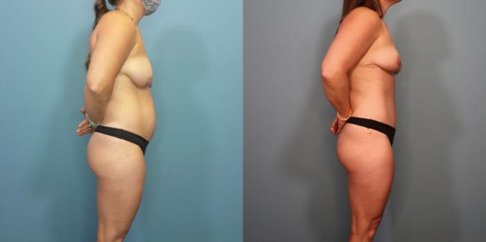 Before & After Tummy Tuck (Abdominoplasty) Case 297 Right Side View in Portland, OR
