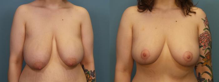 Before & After Breast Reduction Case 304 Front Breast View in Portland, OR