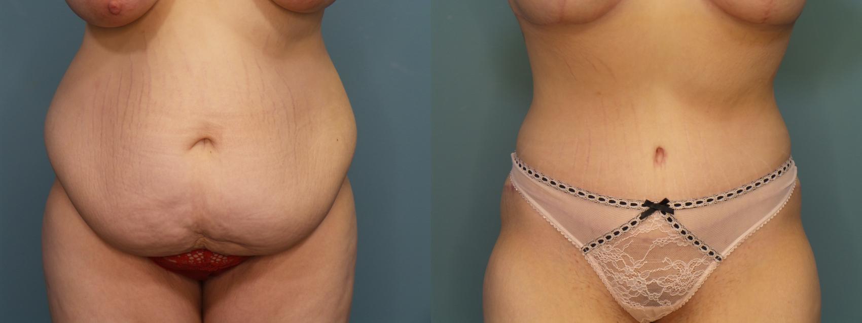 Before & After Tummy Tuck (Abdominoplasty) Case 304 Front View in Portland, OR