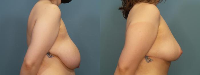 Before & After Tummy Tuck (Abdominoplasty) Case 304 Right Side Breast View in Portland, OR