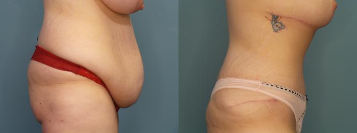 Before & After Tummy Tuck (Abdominoplasty) Case 304 Right Side View in Portland, OR