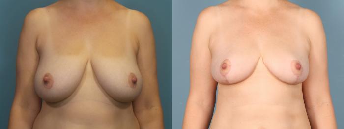 Before & After Mommy Makeover Case 403 Front of Breasts  View in Portland, OR
