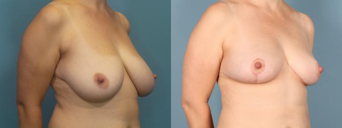 Before & After Mommy Makeover Case 403 Left Oblique of Breasts View in Portland, OR
