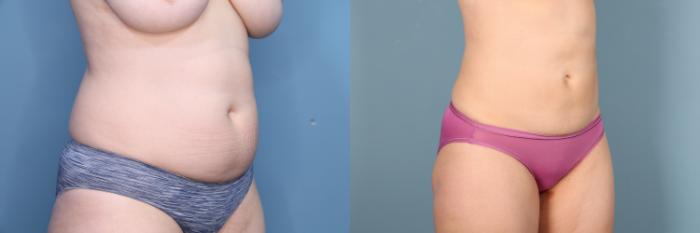 Before & After Mommy Makeover Case 403 Left Oblique View in Portland, OR