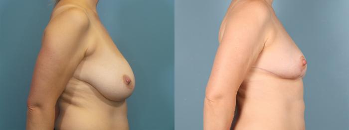 Before & After Mommy Makeover Case 403 Left Side of Breasts View in Portland, OR