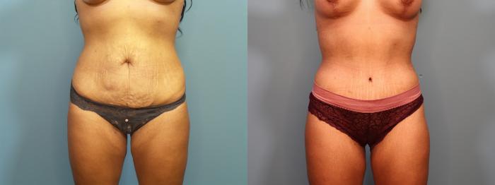 Before & After Mommy Makeover Case 406 Front of Abdomen View in Portland, OR