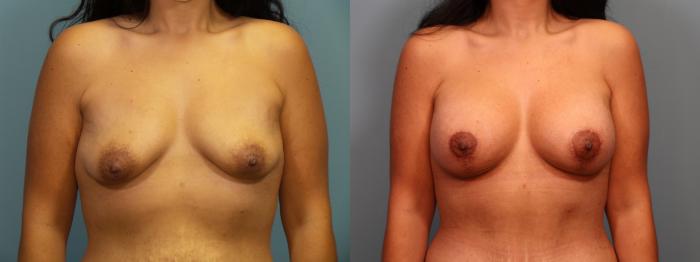 Before & After Breast Lift with Implants Case 406 Front View in Portland, OR