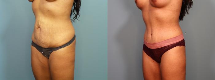 Before & After Tummy Tuck (Abdominoplasty) Case 406 Left Oblique of Abdomen View in Portland, OR