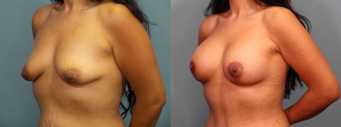 Before & After Tummy Tuck (Abdominoplasty) Case 406 Left Oblique View in Portland, OR