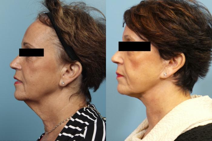 Before & After Neck Lift/ Lower Facelift Case 105 View #1 View in Portland, OR