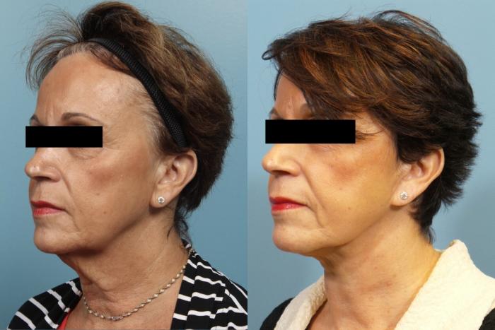 Before & After Neck Lift/ Lower Facelift Case 105 View #2 View in Portland, OR