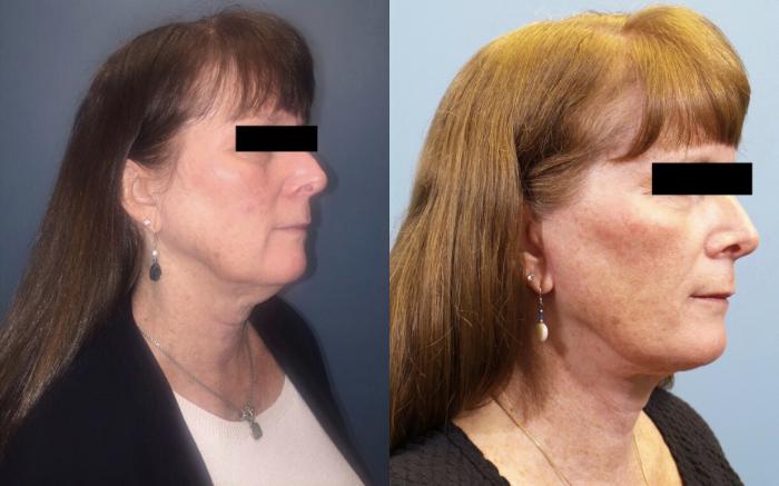 Before & After Neck Lift/ Lower Facelift Case 106 View #2 View in Portland, OR